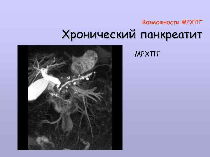 Мрхпг это. Магнитно резонансная холангиопанкреатография МРХПГ. МРХПГ поджелудочной железы. Магнитно-резонансная холангиография желчного пузыря. МРХПГ хронический панкреатит.