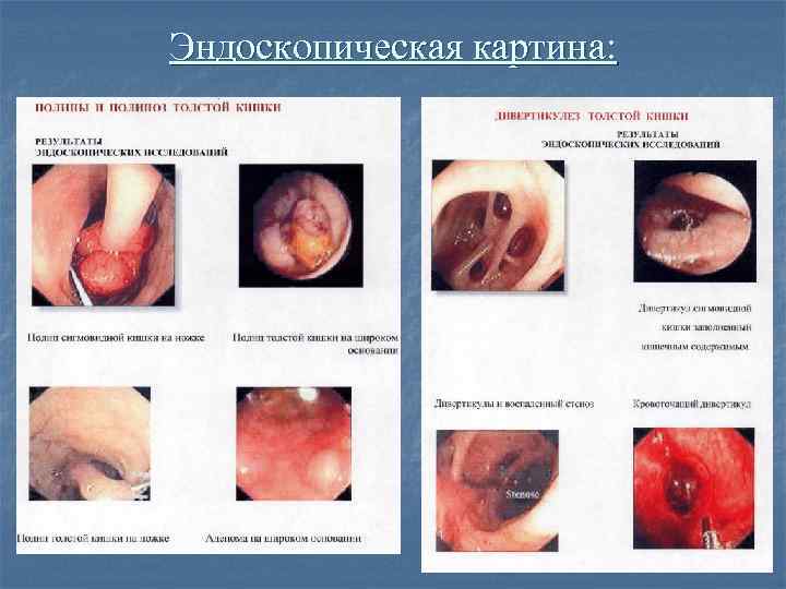 Эндоскопическая картина: 