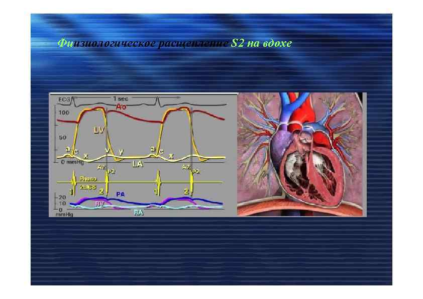 Фиизиологическое расщепление S 2 на вдохе 