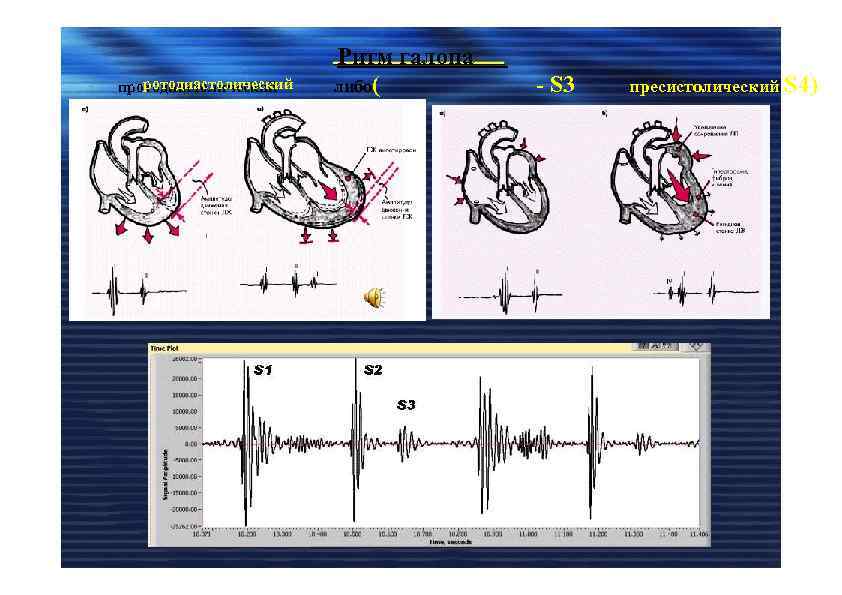 ротодиастолический протодиастолический Ритм галопа либо( - S 3 пресистолический S 4) 