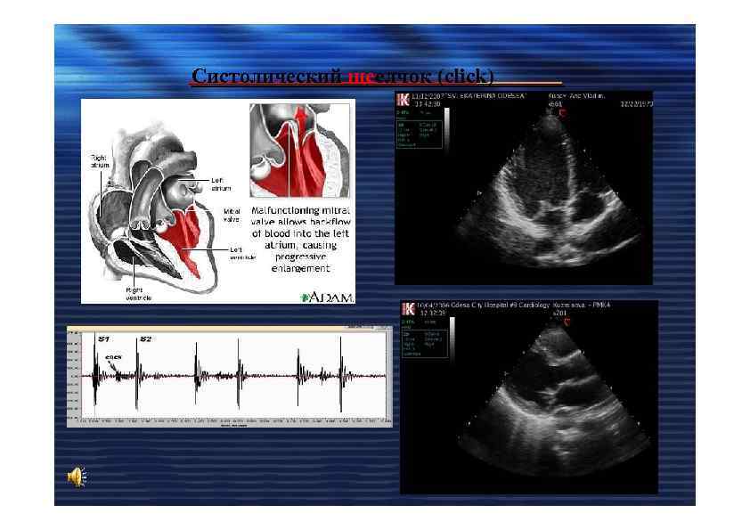 Систолический щеелчок (click) 