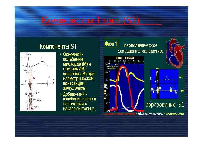 Компоненты I тона (S 1) 