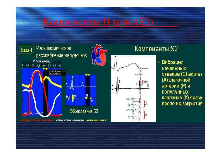 Компоненты II тона (S 2) 