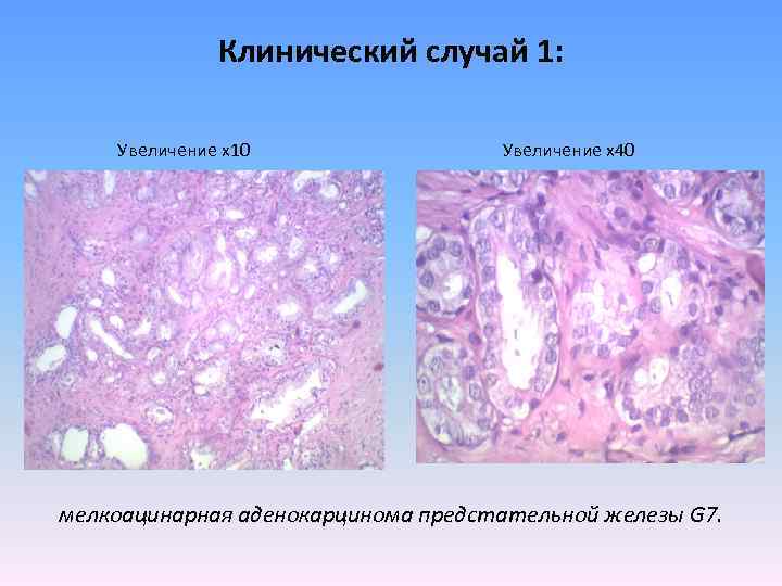 Клинический случай 1: Увеличение х10 Увеличение х40 мелкоацинарная аденокарцинома предстательной железы G 7. 