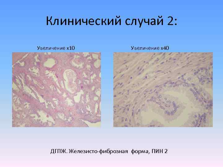 Клинический случай 2: Увеличение х10 Увеличение х40 ДГПЖ. Железисто-фиброзная форма, ПИН 2 