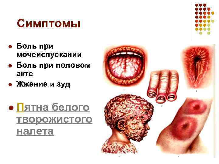 Симптомы l l Боль при мочеиспускании Боль при половом акте Жжение и зуд Пятна