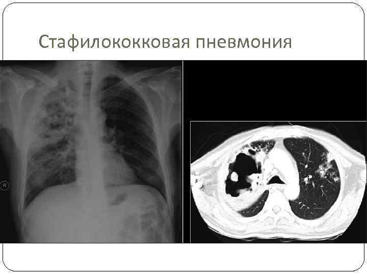 Клиническая картина пневмонии