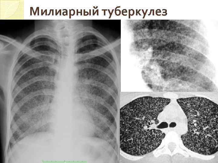 Милиарный туберкулез 