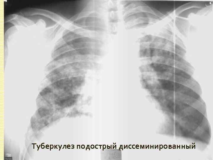 Туберкулез подострый диссеминированный 