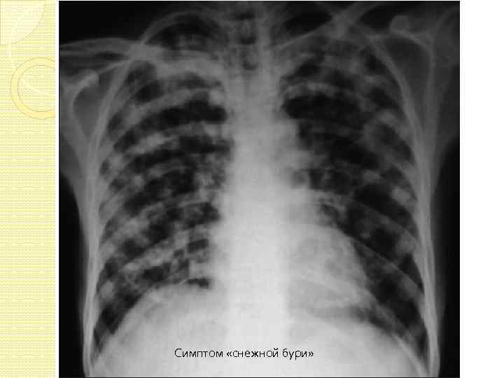 Симптом «снежной бури» 
