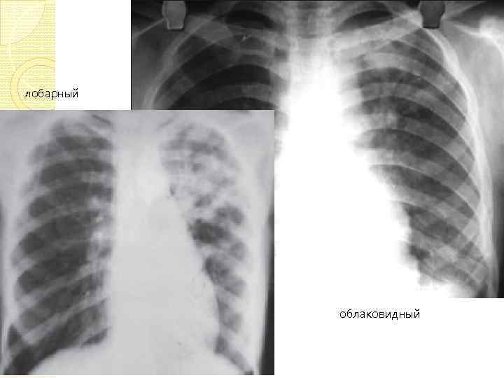 лобарный облаковидный 