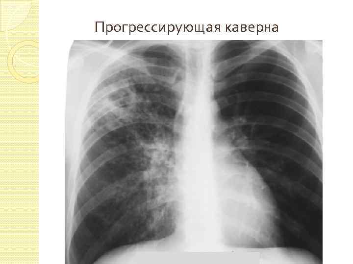 Прогрессирующая каверна 