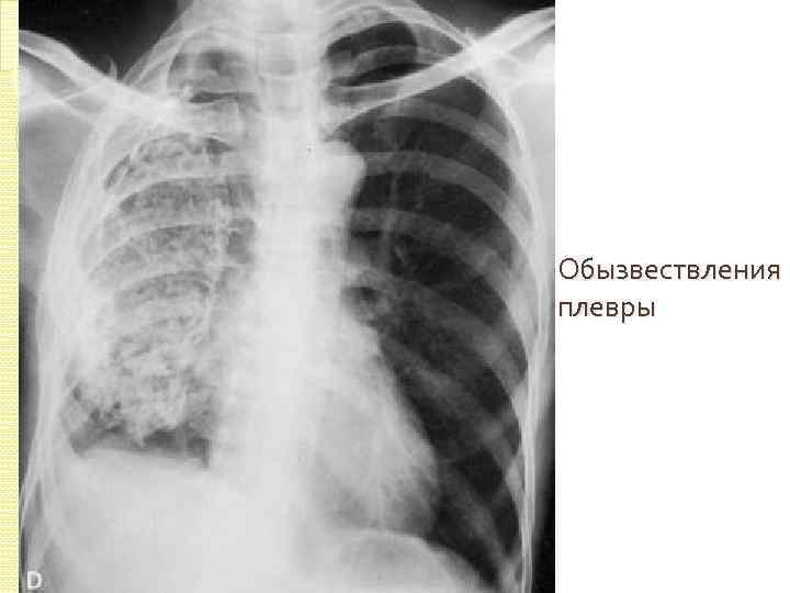 Обызвествления плевры 