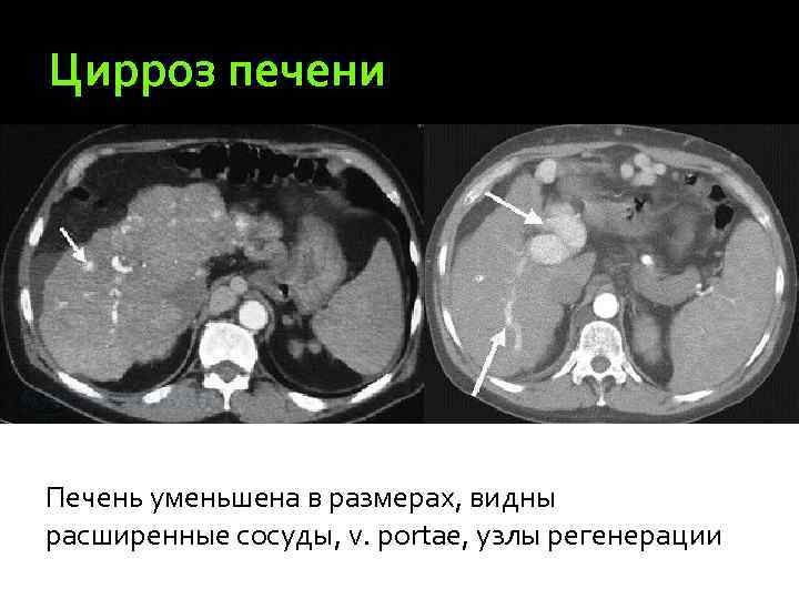 Цирроз печени Печень уменьшена в размерах, видны расширенные сосуды, v. portae, узлы регенерации 