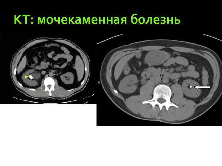 КТ: мочекаменная болезнь 