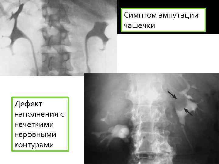 Симптом ампутации чашечки Дефект наполнения с нечеткими неровными контурами 