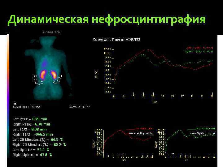 Динамическая нефросцинтиграфия 