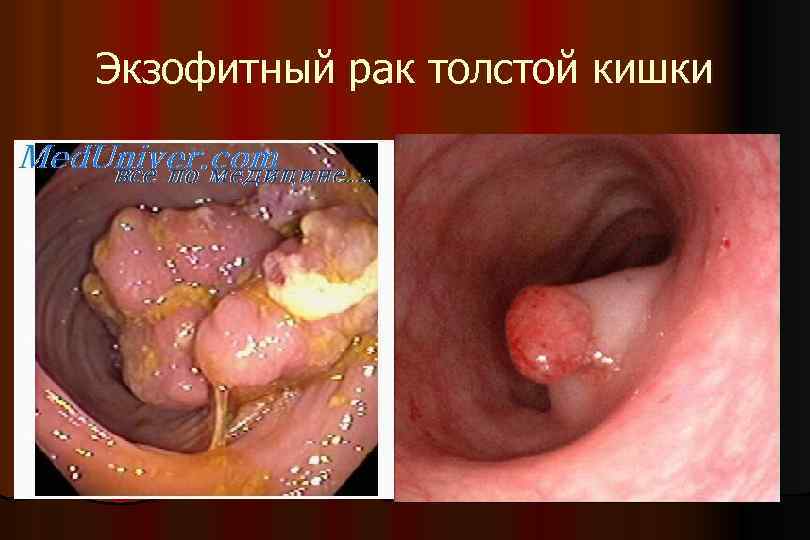 Экзофитный рак толстой кишки 