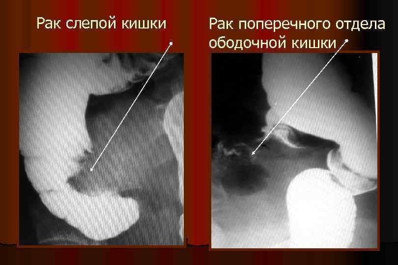 Рак слепой кишки Рак поперечного отдела ободочной кишки 