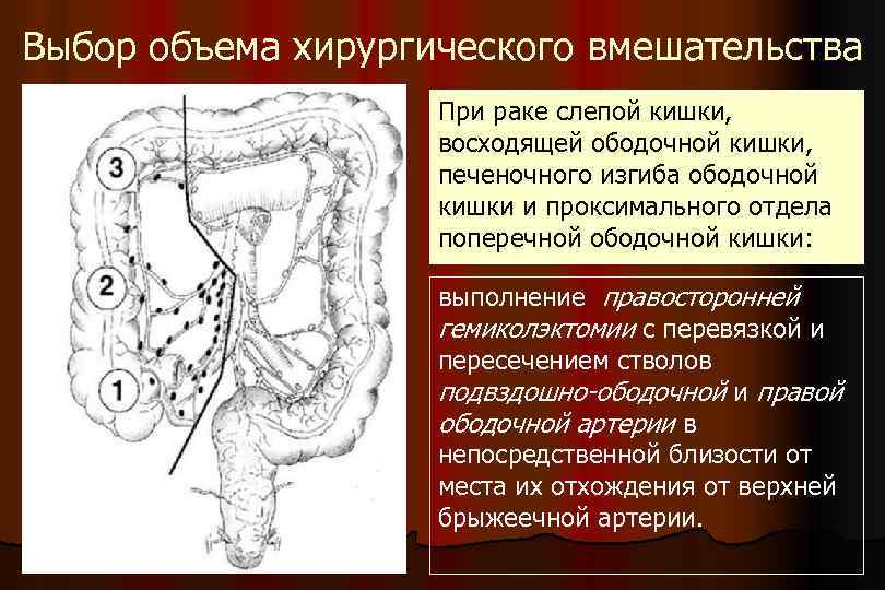 Выбор объема хирургического вмешательства При раке слепой кишки, восходящей ободочной кишки, печеночного изгиба ободочной