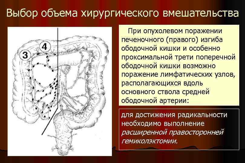 Выбор объема хирургического вмешательства При опухолевом поражении печеночного (правого) изгиба ободочной кишки и особенно