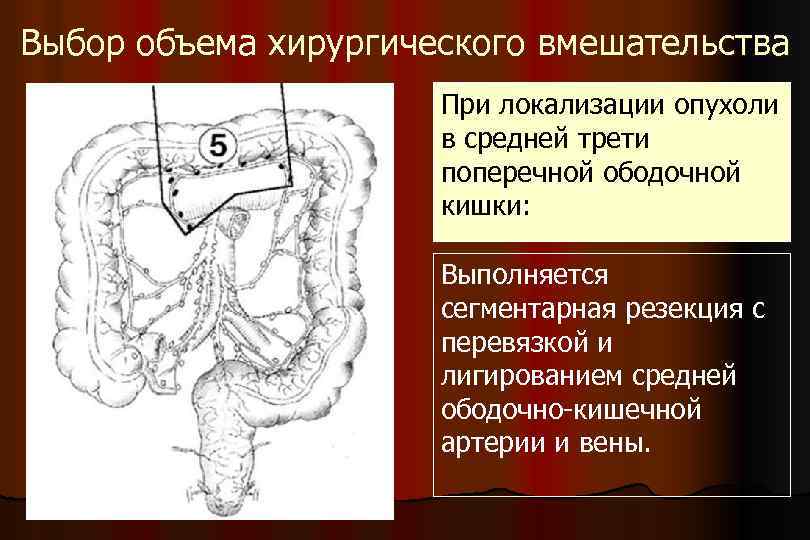 Выбор объема хирургического вмешательства При локализации опухоли в средней трети поперечной ободочной кишки: Выполняется