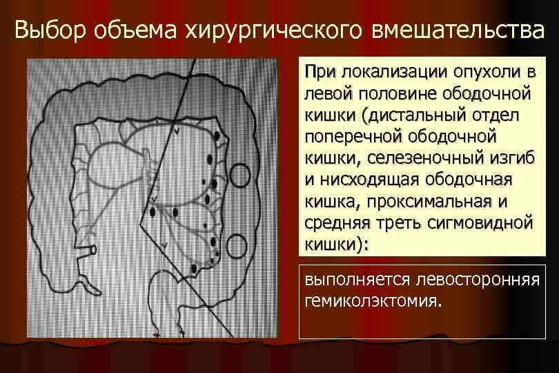 Выбор объема хирургического вмешательства При локализации опухоли в левой половине ободочной кишки (дистальный отдел