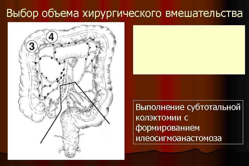 Выбор объема хирургического вмешательства Выполнение субтотальной колэктомии с формированием илеосигмоанастомоза 