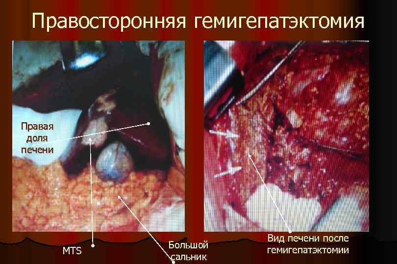 Правосторонняя гемигепатэктомия Правая доля печени MTS Большой сальник Вид печени после гемигепатэктомии 