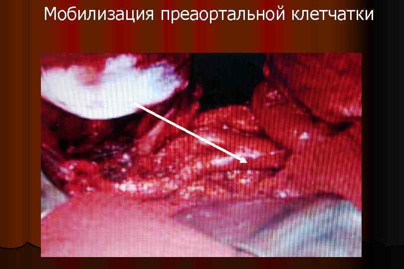  Мобилизация преаортальной клетчатки Аорта Нижняя полая вена 