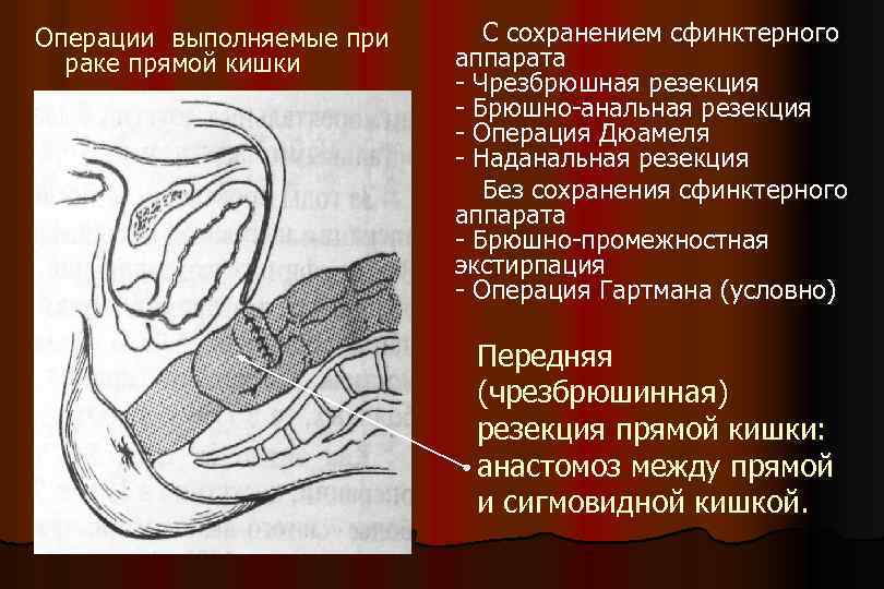 Операции выполняемые при раке прямой кишки С сохранением сфинктерного аппарата - Чрезбрюшная резекция -