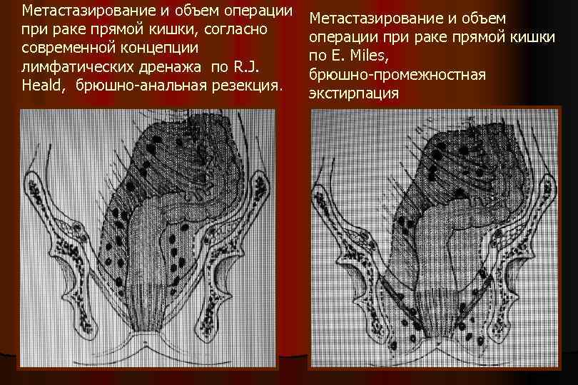 Метастазирование и объем операции при раке прямой кишки, согласно современной концепции лимфатических дренажа по