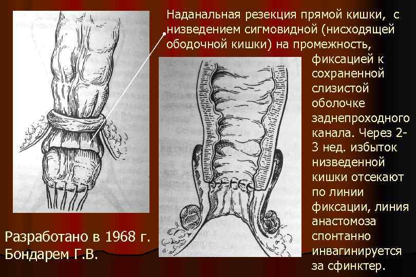 Наданальная резекция прямой кишки, с низведением сигмовидной (нисходящей ободочной кишки) на промежность, фиксацией к