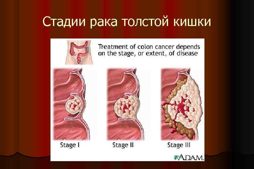 Стадии рака толстой кишки 