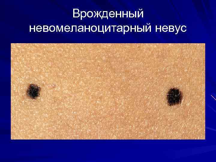 Врожденный невомеланоцитарный невус 