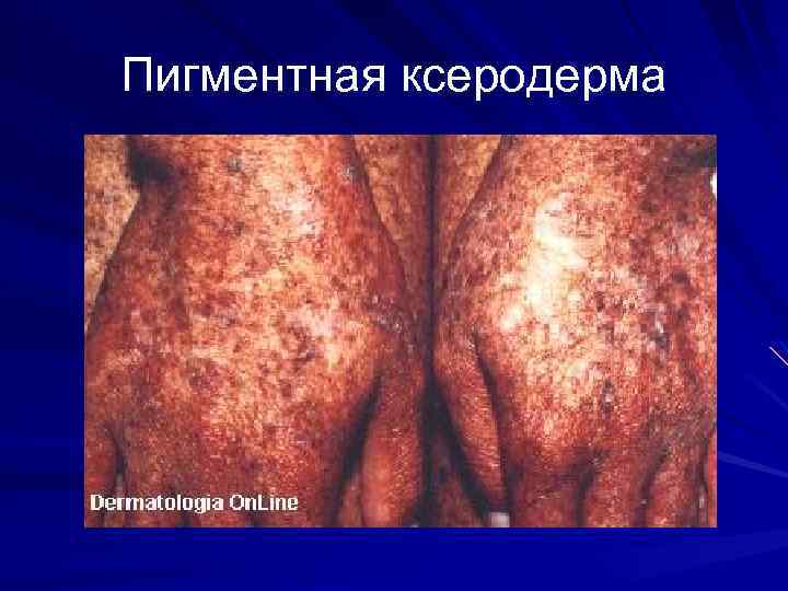 Пигментная ксеродерма 