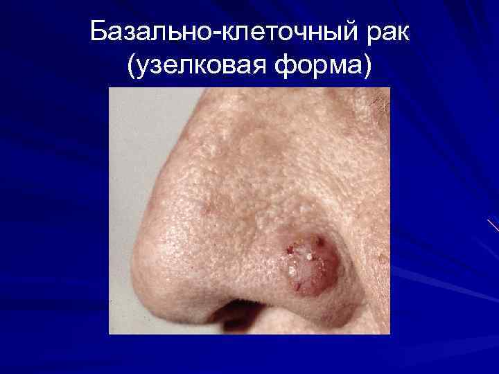 Базально-клеточный рак (узелковая форма) 