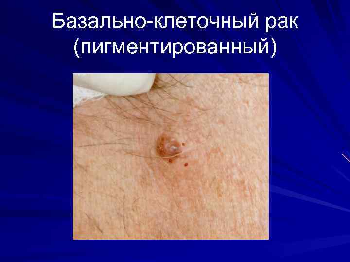 Базально-клеточный рак (пигментированный) 