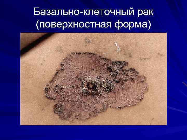 Базально-клеточный рак (поверхностная форма) 