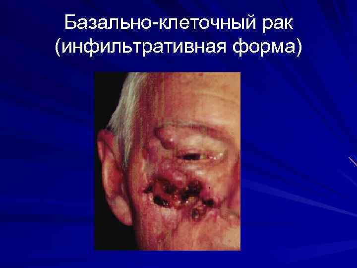 Базально-клеточный рак (инфильтративная форма) 
