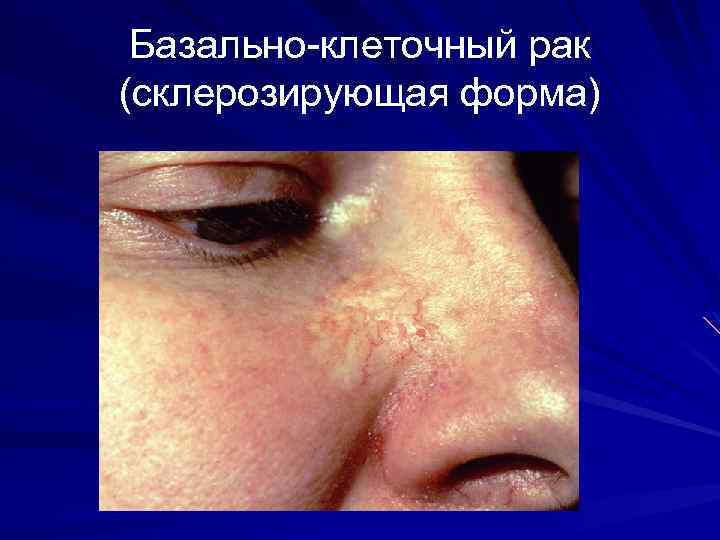Базально-клеточный рак (склерозирующая форма) 