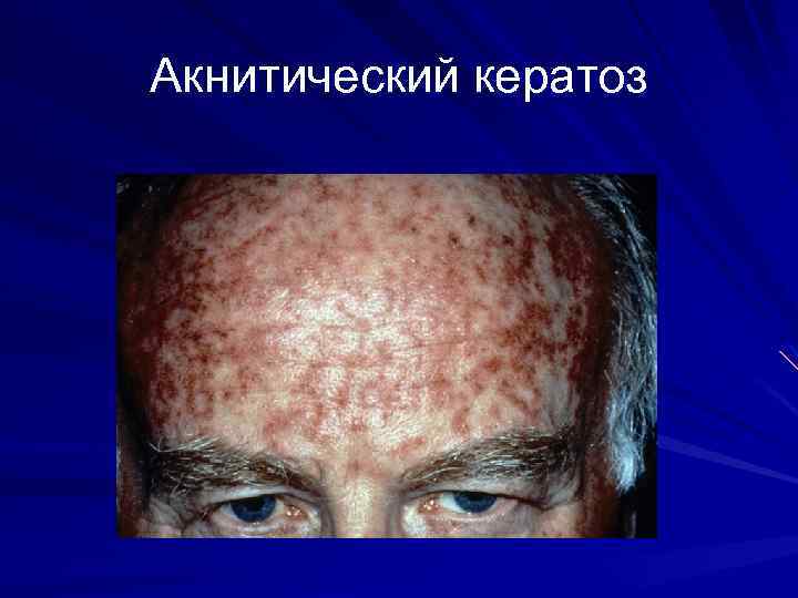 Акнитический кератоз 