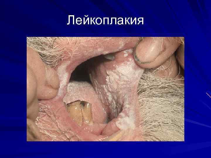 Лейкоплакия 