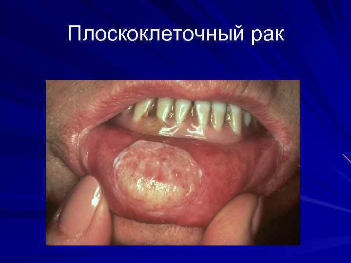 Плоскоклеточный рак 