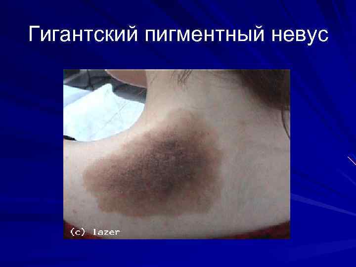 Гигантский пигментный невус 