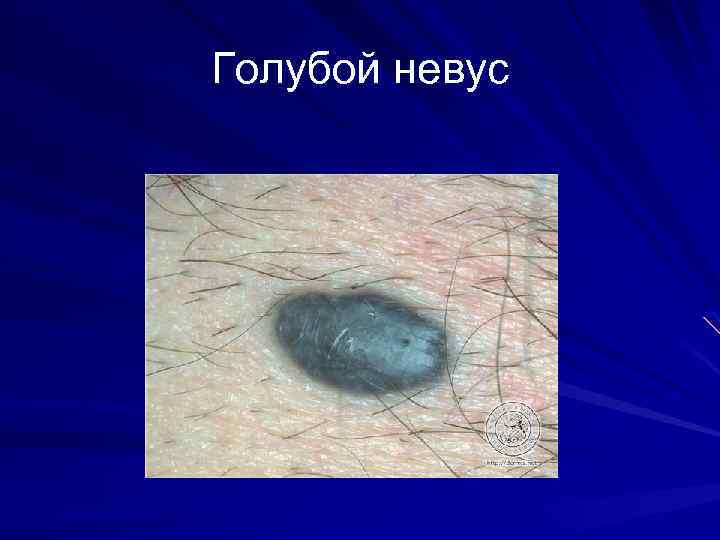 Голубой невус 
