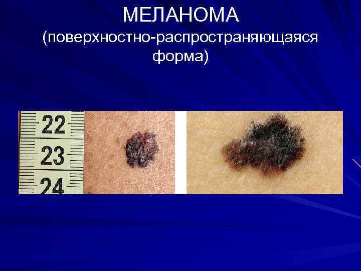 МЕЛАНОМА (поверхностно-распространяющаяся форма) 