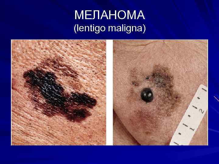 МЕЛАНОМА (lentigo maligna) 