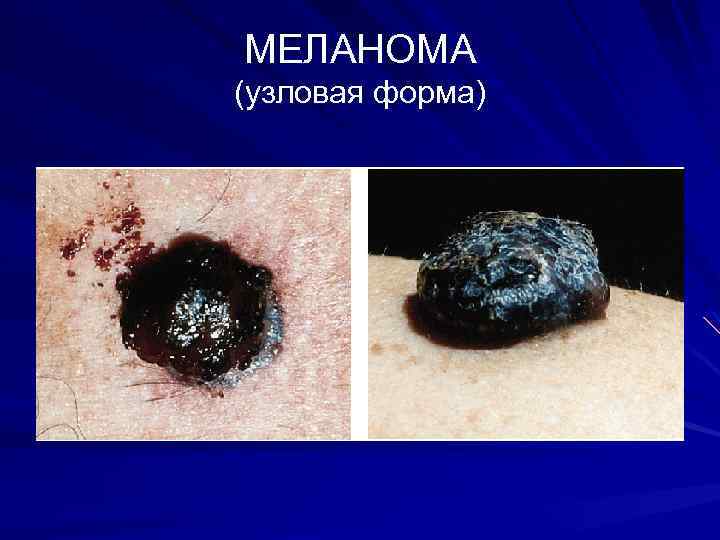 МЕЛАНОМА (узловая форма) 