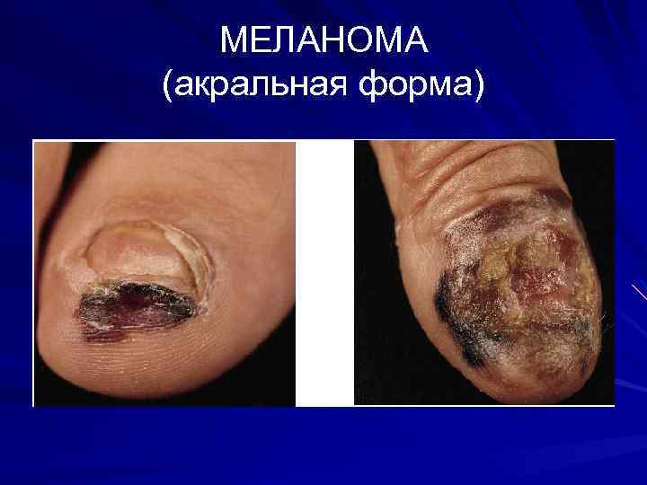 МЕЛАНОМА (акральная форма) 